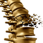 La diabetes y la salud de los huesos