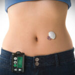 Investigadores en Colorado ayudan con el sistema de páncreas artificial para la diabetes tipo I en pacientes con diabetes