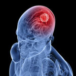 El Dr. Sanjay Kalra explica cómo la diabetes puede aumentar el riesgo de sufrir un accidente cerebrovascular y cómo se puede evitar