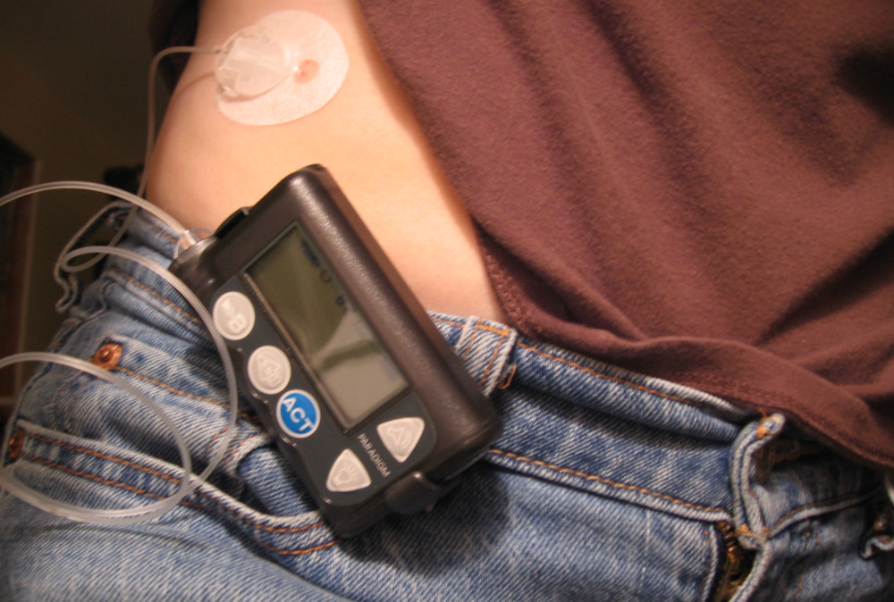 La bomba de insulina podría reducir el riesgo de muertes por enfermedades del corazón para los diabéticos tipo 1