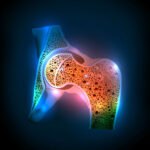 La osteoporosis y la diabetes: pros y contras de los regímenes antidiabéticos